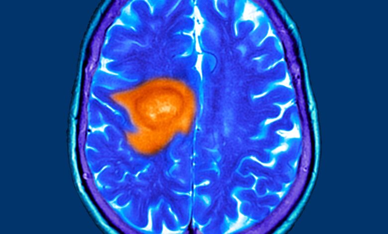 Novel CAR-T for Glioblastoma Induced ‘Dramatic’ Responses in Early Trial