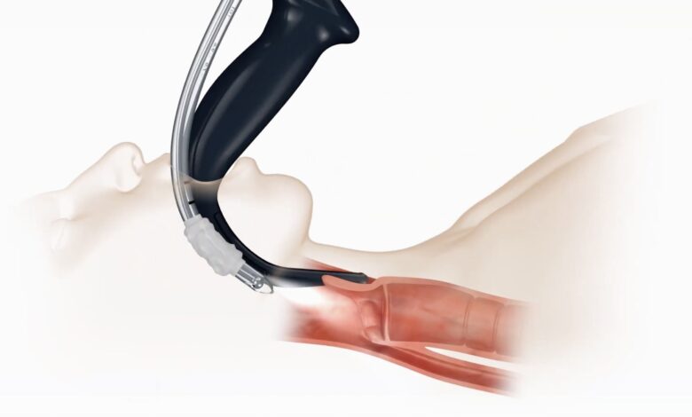 Use of Video Laryngoscopy Reduced Endotracheal Intubation Attempts