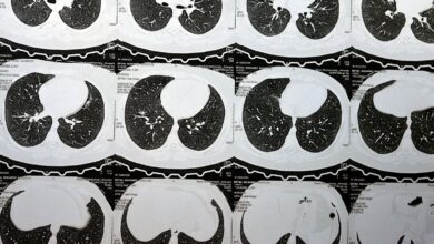 Progressing Interstitial Lung Abnormalities Linked to Respiratory Distress