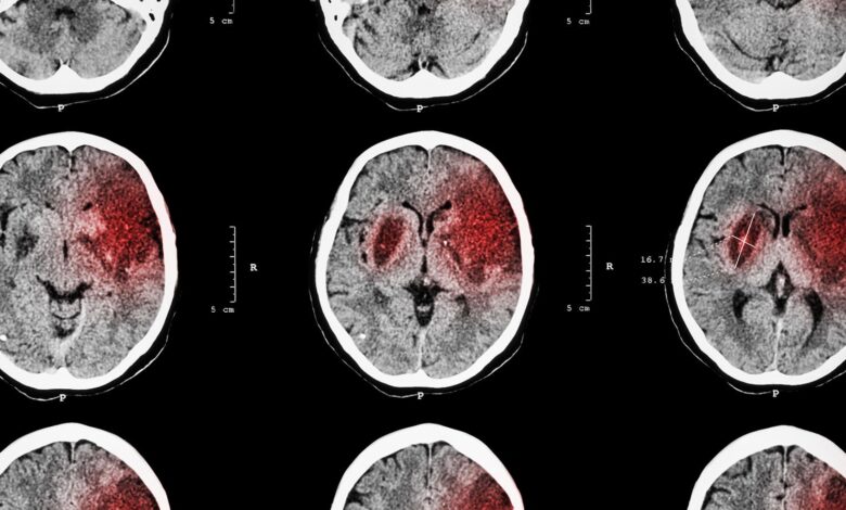 Late-Window Tenecteplase for Stroke Works When Thrombectomy’s Out of the Question