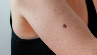 3 Types of Skin Cancer That Should Be on Everyone’s Radar