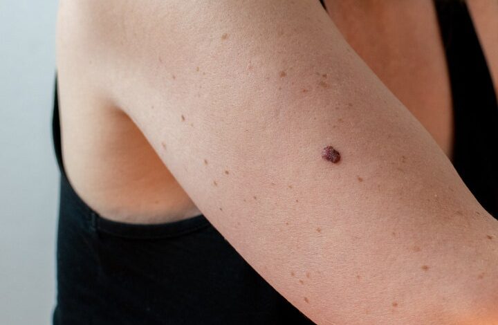 3 Types of Skin Cancer That Should Be on Everyone’s Radar