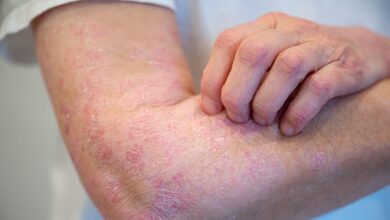 Psoriasis Control Maintained Long Term With Extended Dosing Interval of Guselkumab