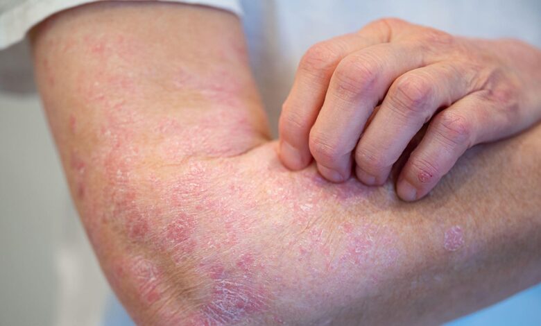 Psoriasis Control Maintained Long Term With Extended Dosing Interval of Guselkumab