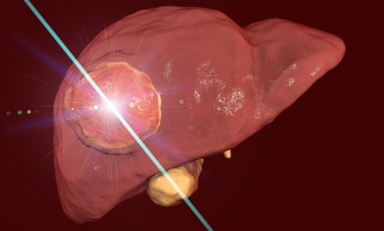 Favorable Outcomes With Microwave Ablation for Colorectal Liver Metastases