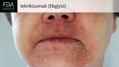 Lebrikizumab Wins FDA Approval for Eczema