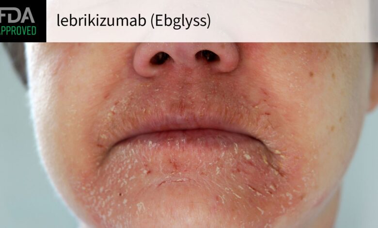 Lebrikizumab Wins FDA Approval for Eczema