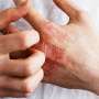 Long-term efficacy for lebrikizumab seen in moderate, severe eczema