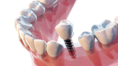 A new dental scam is to pull healthy teeth to sell you expensive fake ones