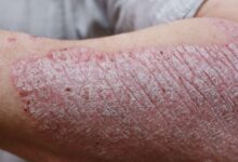 Could Psoriasis Treatment Be This Simple?