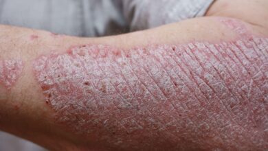 Could Psoriasis Treatment Be This Simple?