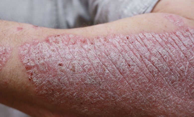 Could Psoriasis Treatment Be This Simple?