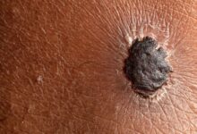 Childhood Cancer Survivors Have Double the Risk of Melanoma as Adults