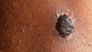 Childhood Cancer Survivors Have Double the Risk of Melanoma as Adults