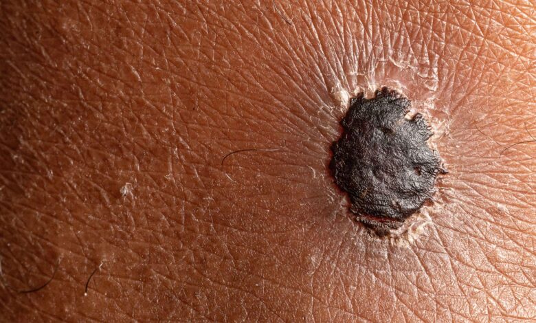 Childhood Cancer Survivors Have Double the Risk of Melanoma as Adults