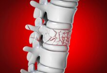 Infrequent Zoledronate Infusions Reduced Vertebral Fractures Soon After Menopause