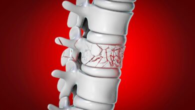 Infrequent Zoledronate Infusions Reduced Vertebral Fractures Soon After Menopause