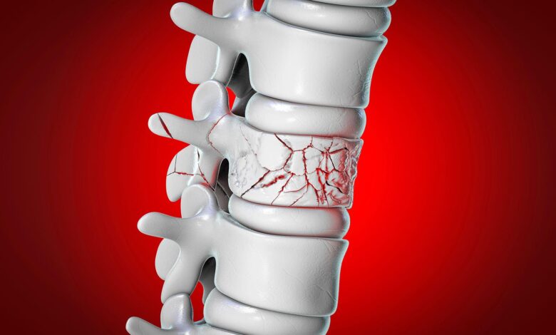 Infrequent Zoledronate Infusions Reduced Vertebral Fractures Soon After Menopause