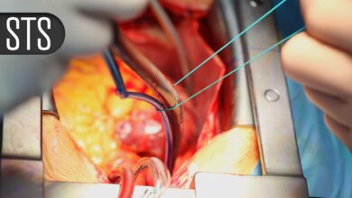 Heart Surgeons Wary of Being ‘Left Behind’ in Tricuspid Innovation