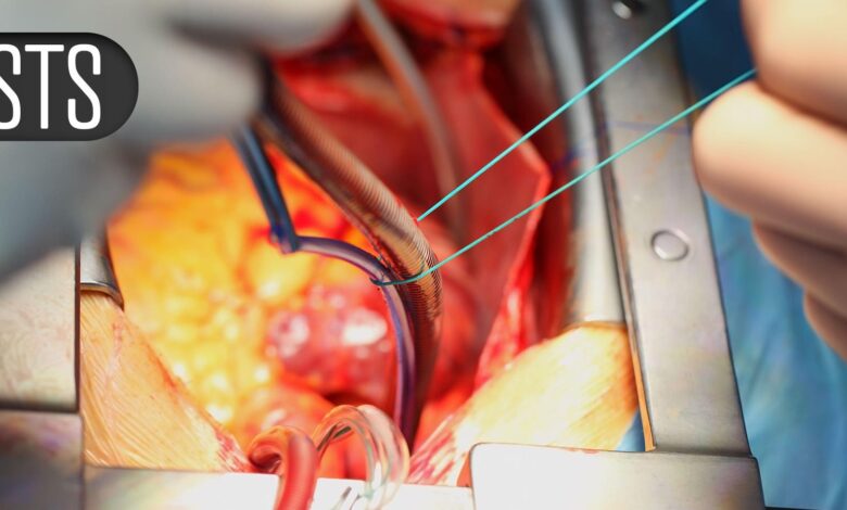 Heart Surgeons Wary of Being ‘Left Behind’ in Tricuspid Innovation