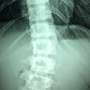 Spinal cord electrical stimulation restores neural function in clinical trial