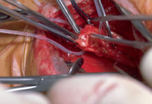 Clot-Busting Ultrasound Gives Carotid Endarterectomy a Step Up