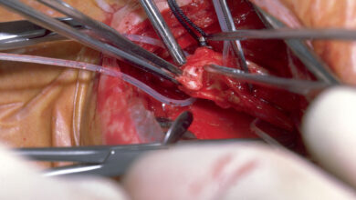 Clot-Busting Ultrasound Gives Carotid Endarterectomy a Step Up