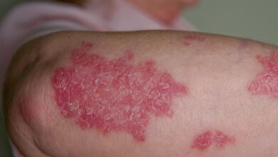 Certain Autoimmune Skin Diseases Linked to Better Cancer Prognosis