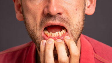 ‘Ozempic Teeth:’ Another Effect of GLP-1 Agonists?