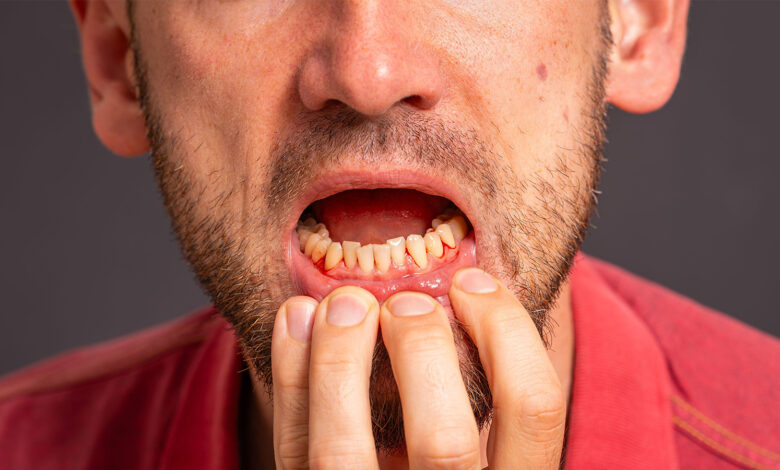 ‘Ozempic Teeth:’ Another Effect of GLP-1 Agonists?