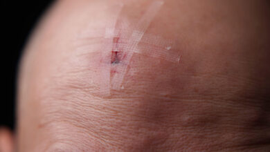 Risk of Malignant Tumor Rises After Traumatic Brain Injury