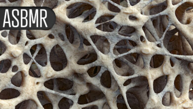 Few Long-Term Bone Consequences After Teen Bariatric Surgery