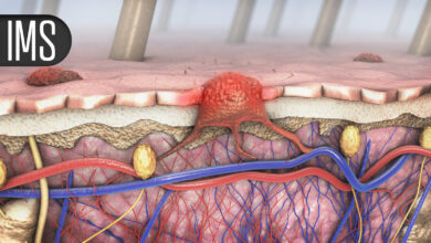 Quadruplet Promising in Older Patients With Transplant-Ineligible Multiple Myeloma