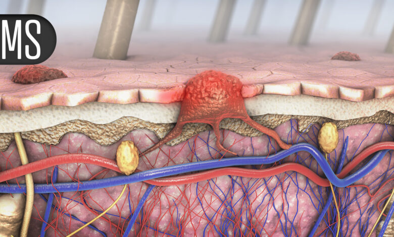 Quadruplet Promising in Older Patients With Transplant-Ineligible Multiple Myeloma